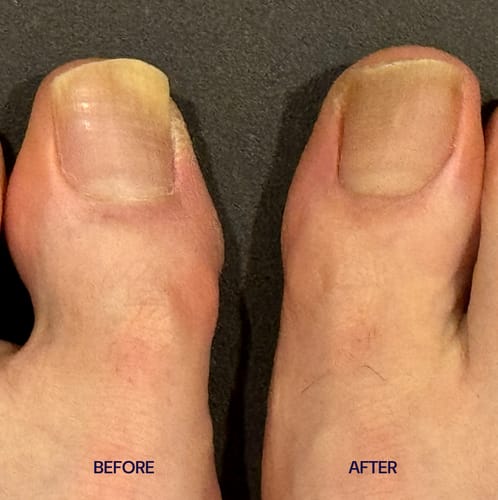 Customer photo review of NUVEX Multi-Nail LED Anti-Fungus Kit