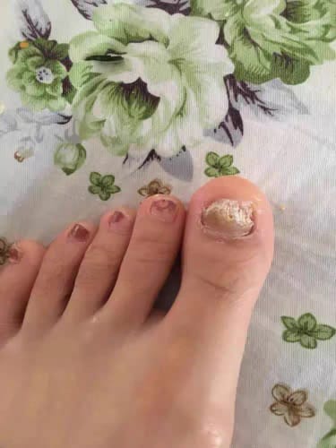 Customer photo review of NUVEX-Multi-Nail LED Anti-Fungus Kit