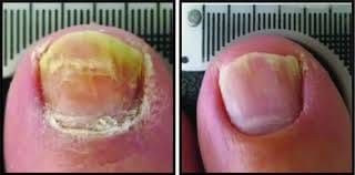 Customer photo review of NUVEX-Multi-Nail LED Anti-Fungus Kit