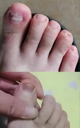 Customer photo review of NUVEX Multi-Nail LED Anti-Fungus Kit