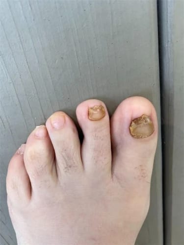 Customer photo review of NUVEX Multi-Nail LED Anti-Fungus Kit