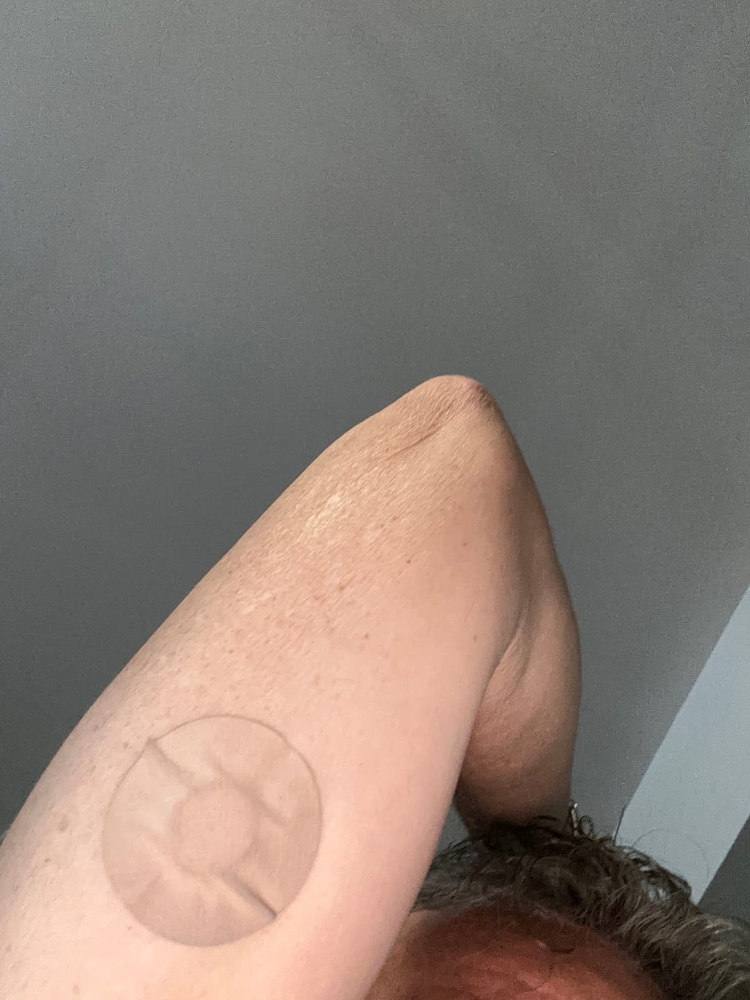 Customer photo review of Skin Grip MAX Freestyle Libre 3 Patches - 10 Pack