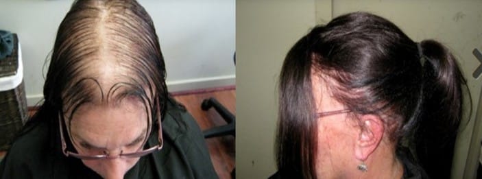 Customer photo review of LIVDOR Laser Hair Growth Cap