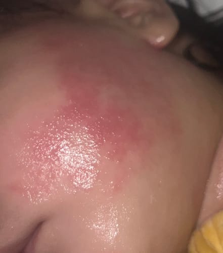 Customer photo review of All Over Ointment Eczema Treatment