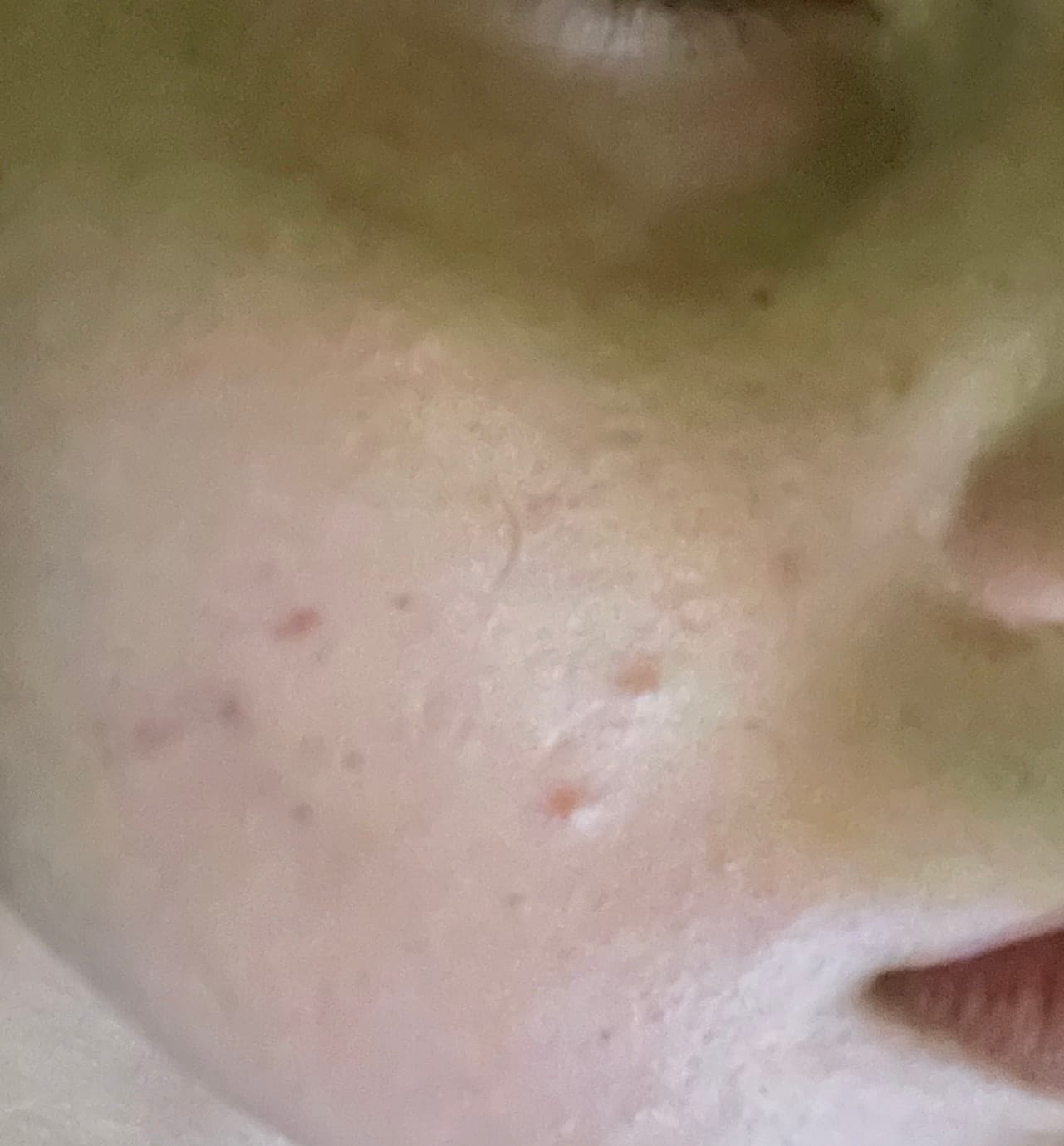 Customer photo review of Clear Skin Rescue