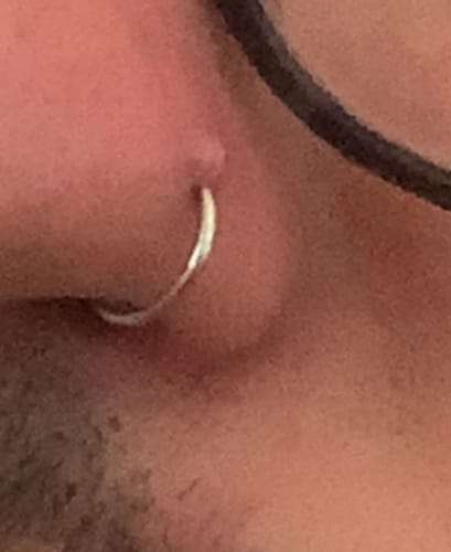 Customer photo review of Piercing Bump Treatment - Bump, Keloid & Scar Relief Oil
