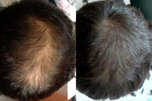 Customer photo review of Infrarot Lichttherapie Kappe™