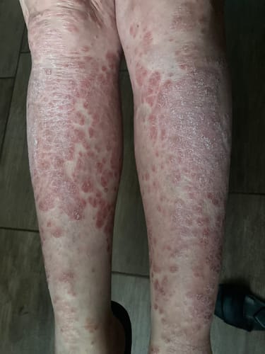 Customer photo review of SERENI Pikkelysömör és Ekcéma Krém