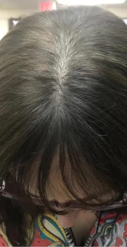 Customer photo review of Infrarot Lichttherapie Kappe™