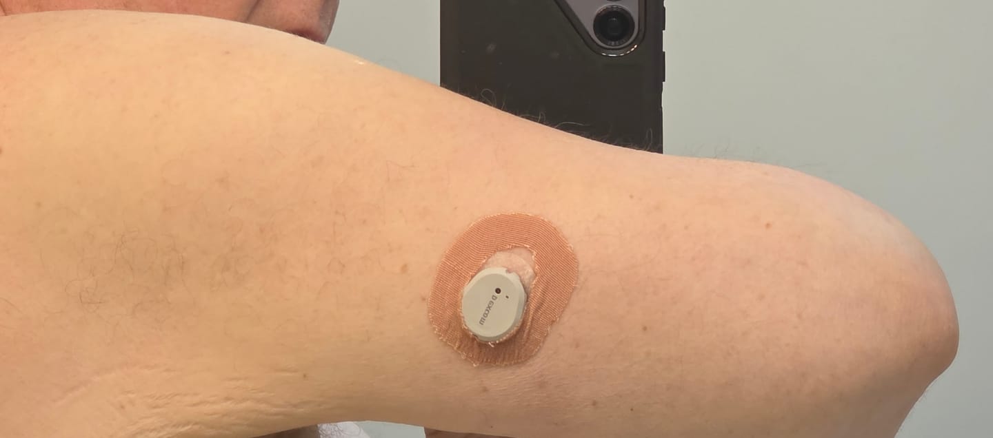 Customer photo review of Skin Grip Original - Dexcom G7 & Stelo Adhesive Patches (With Cutout)