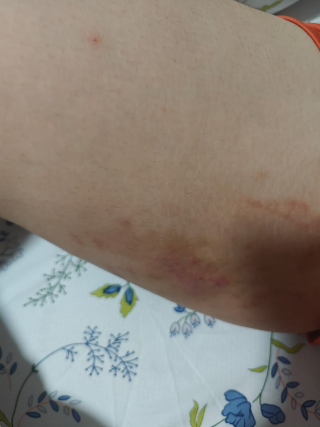 Customer photo review of Balance Fusion Combo (2 RCV + 2 NSE)