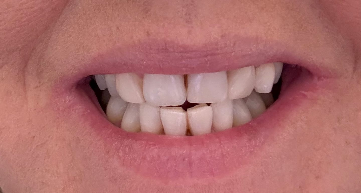 Customer photo review of Sensitive Teeth Whitening Toothpaste