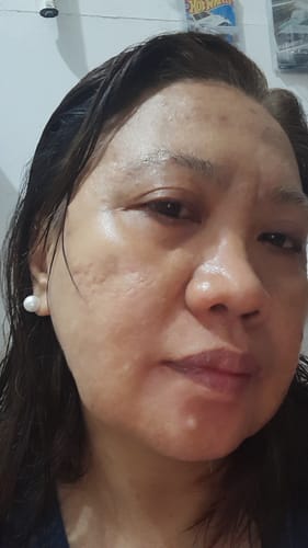 Customer photo review of Bad Skin™ Korean Collagen Bomb Hydrating Ampoule