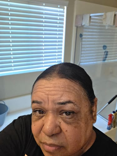 Customer photo review of Hair ReGrowth Serum (Free Gift) - 30% OFF