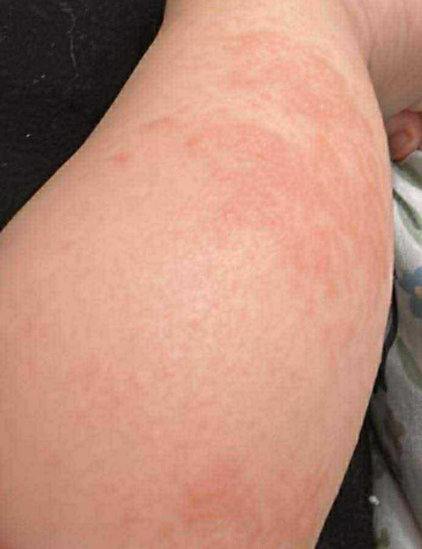 Customer photo review of Bioskin Junior Outbreak Rescue Cream