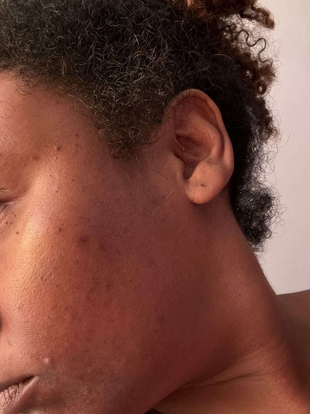 Customer photo review of ZO COMPLEXION RENEWAL PADS (60 pads)
