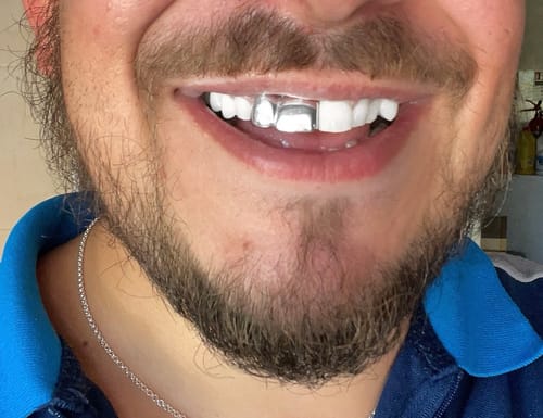 Customer photo review of Front Tooth & Lateral