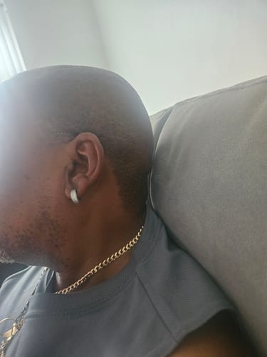 Customer photo review of Anti-Acne & Dark Spots African Soap