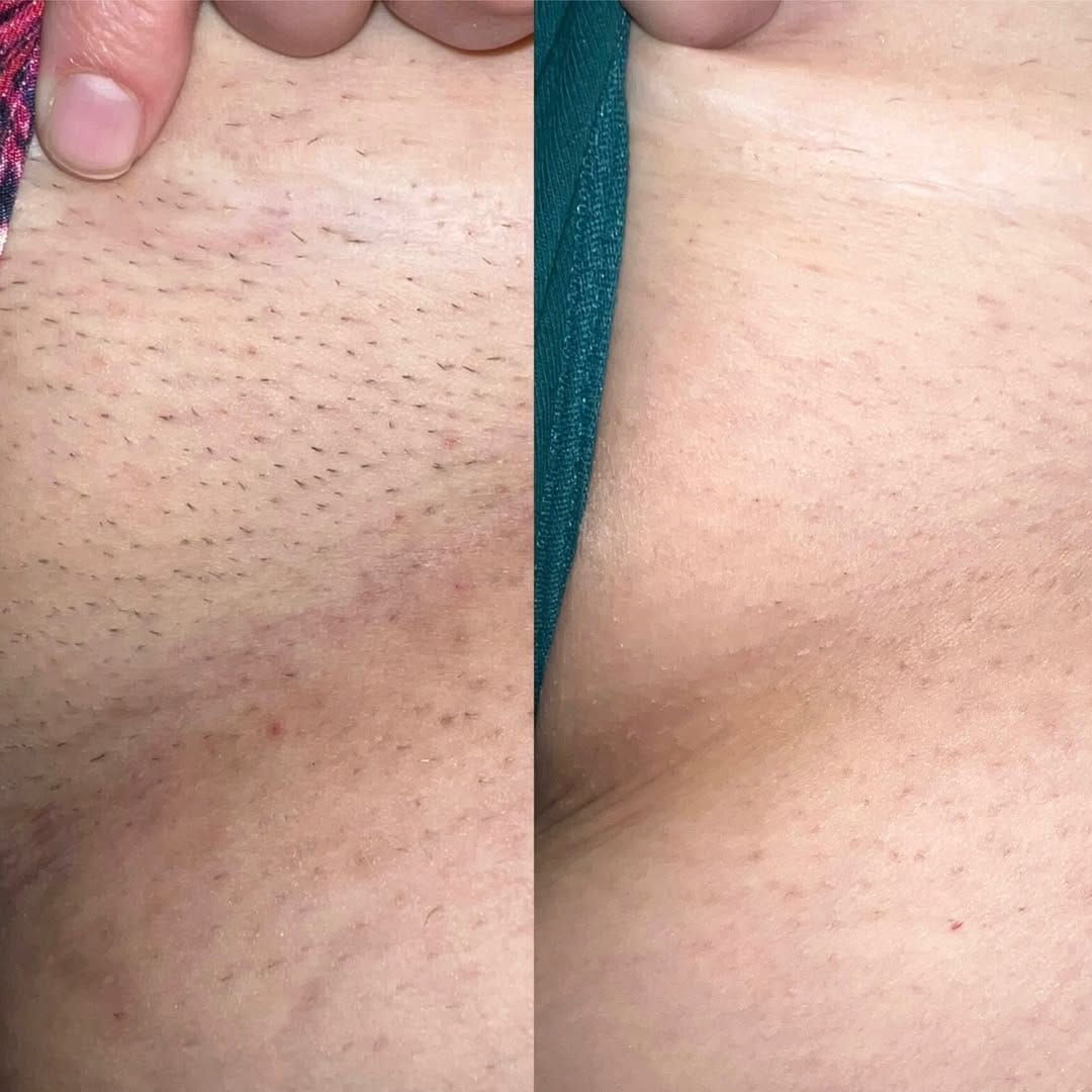 Customer photo review of AT Labs™ Масло Против Окосмяване