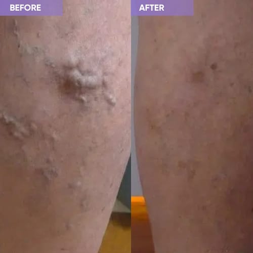 Customer photo review of Thermapulse - VeinErase System