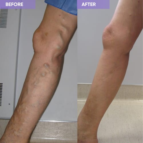 Customer photo review of Thermapulse - VeinErase System