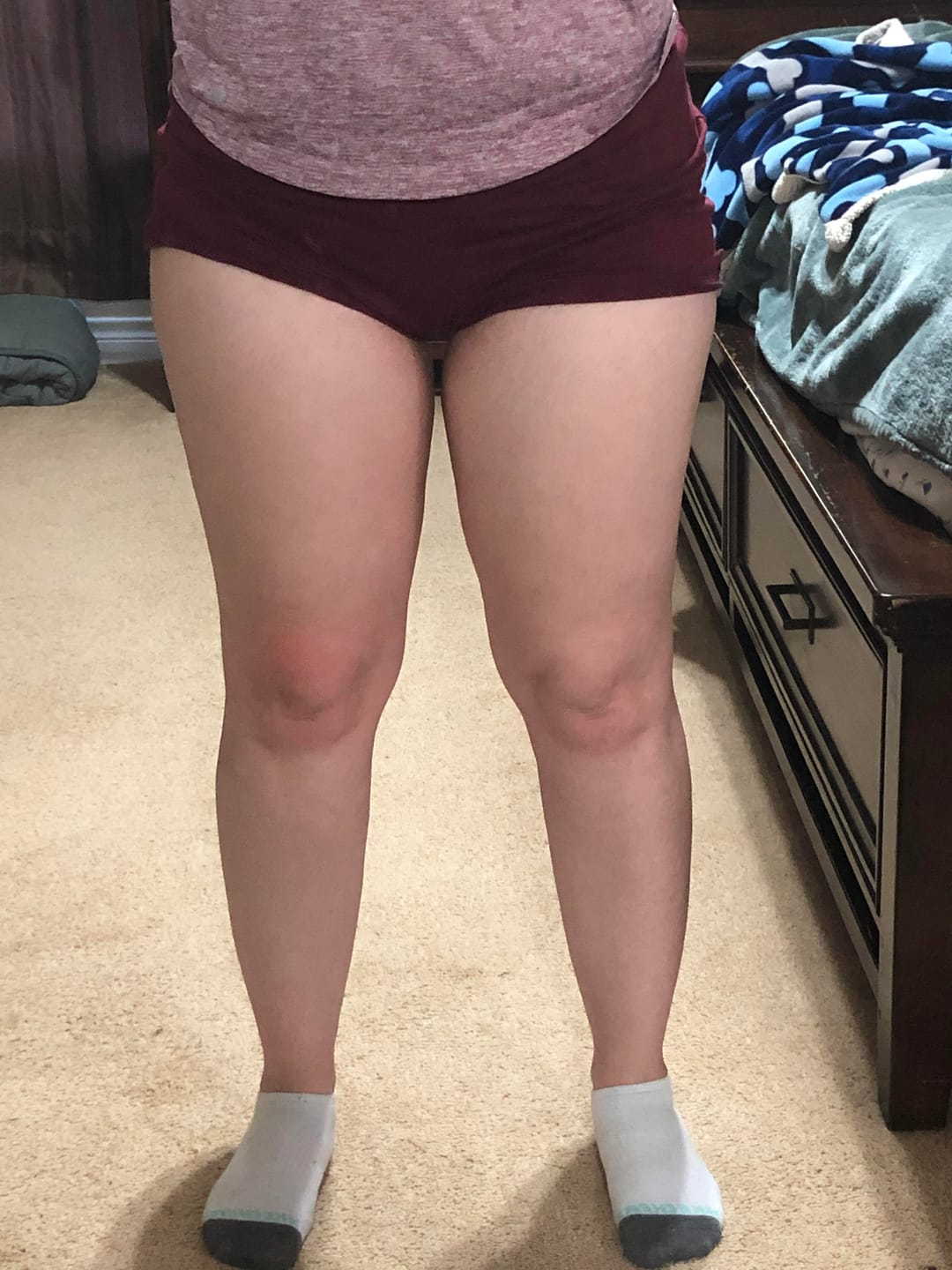 Customer photo review of Thermapulse - VeinErase System