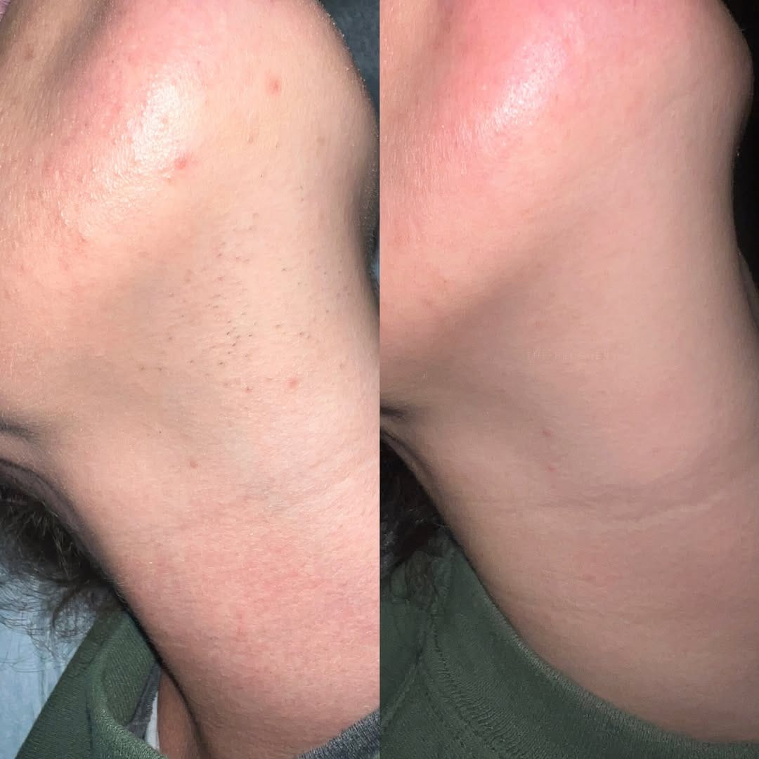 Customer photo review of AT Labs™ Масло Против Окосмяване