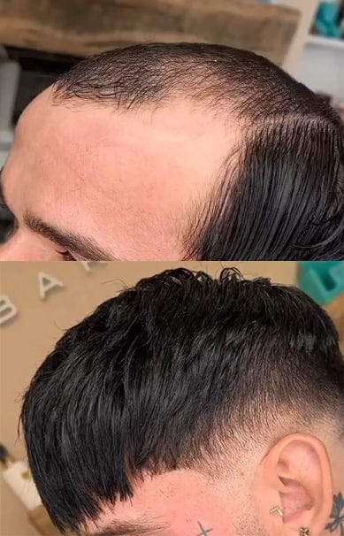 Customer photo review of Men Hair System Charmer Mono Top with PU around the base French lace in front