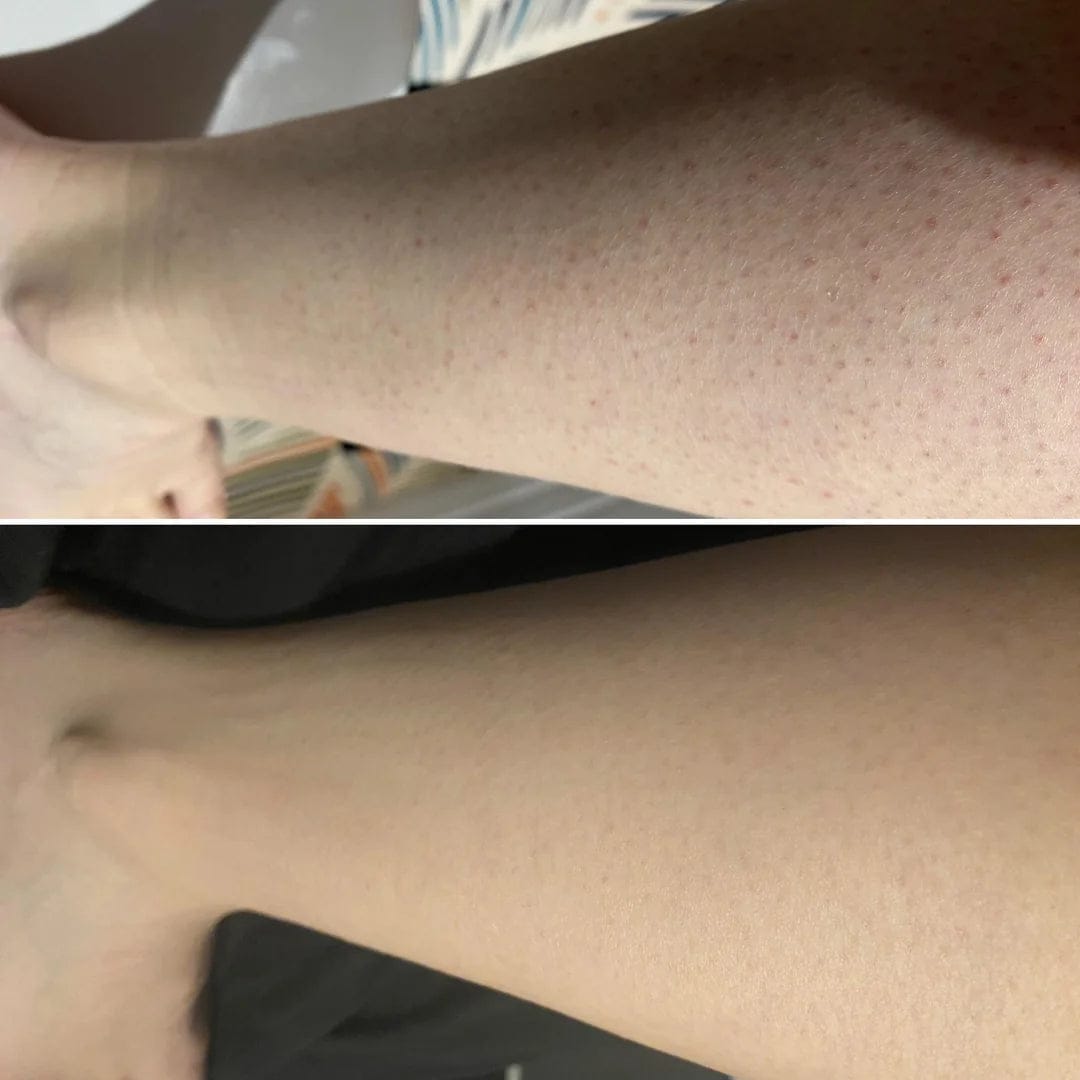 Customer photo review of AT Labs™ Масло Против Окосмяване