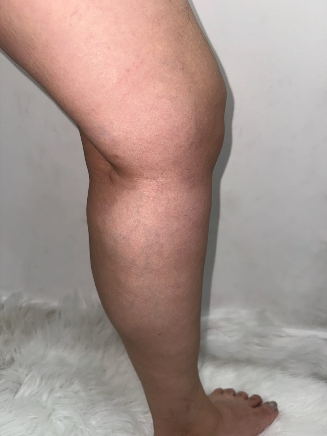 Customer photo review of Thermapulse - VeinErase System