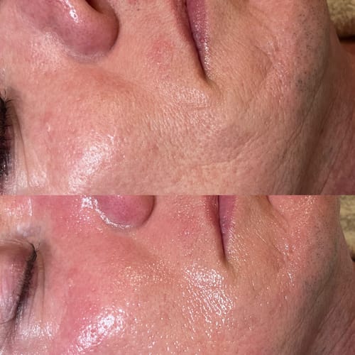 Customer photo review of The Complete Nano Infusion With Topical Fillers Online Course- All You Need to Become a Sought-After Nano-Infusion Specialist in No Time