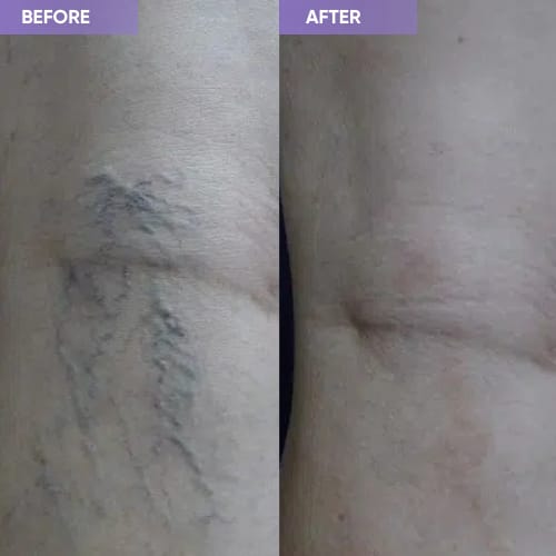 Customer photo review of Thermapulse - VeinErase System