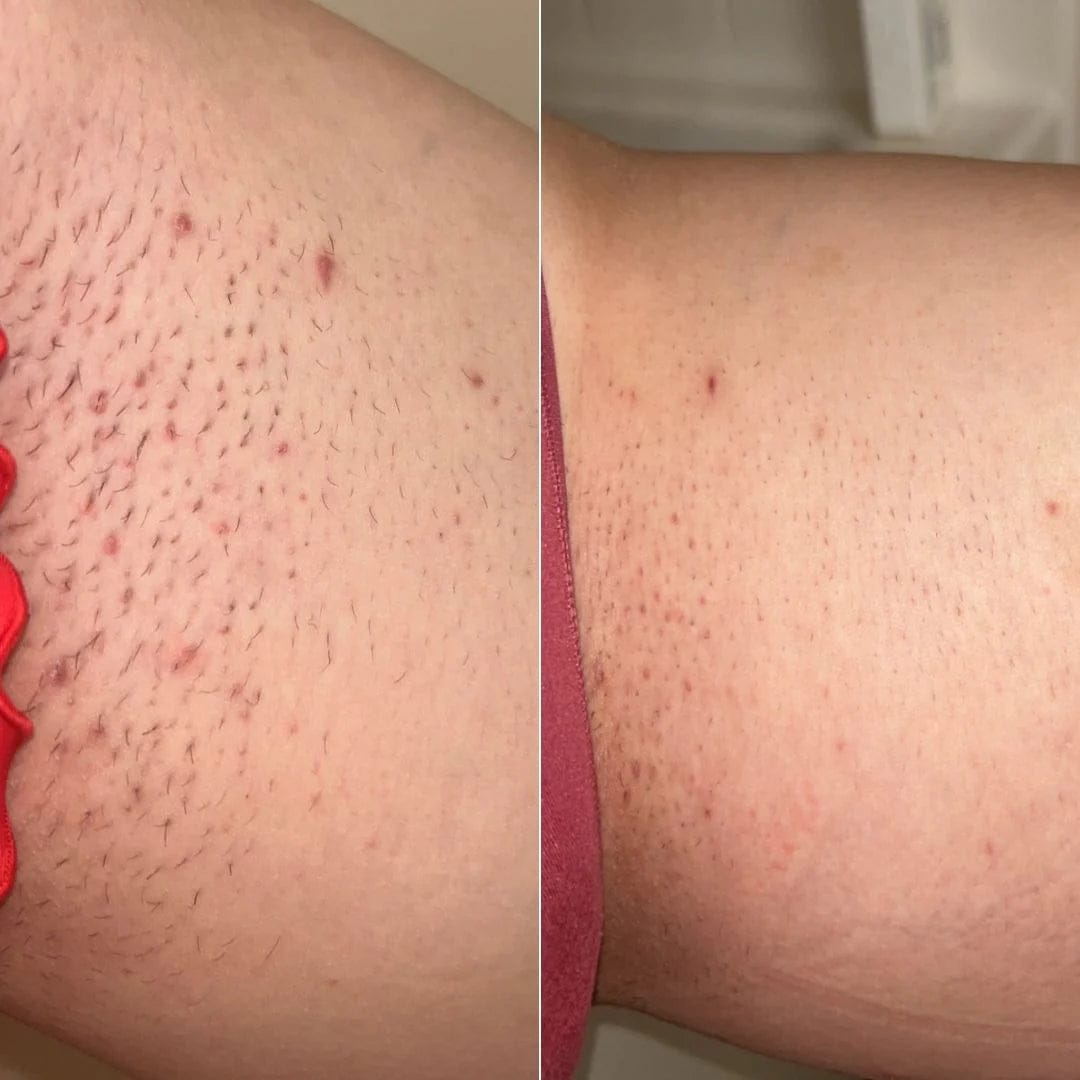 Customer photo review of AT Labs™ Масло Против Окосмяване