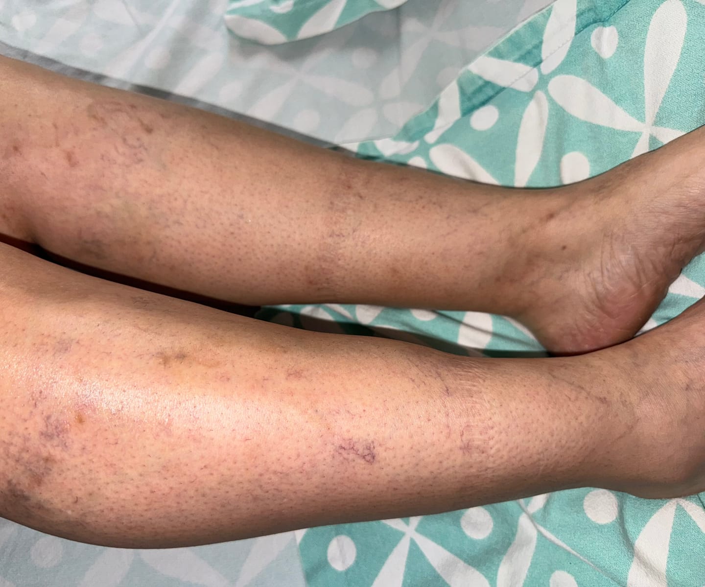 Customer photo review of Thermapulse - VeinErase System