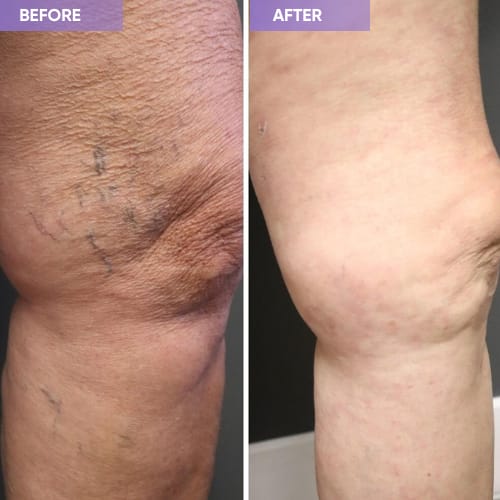 Customer photo review of Thermapulse - VeinErase System