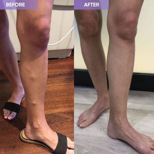 Customer photo review of Thermapulse - VeinErase System