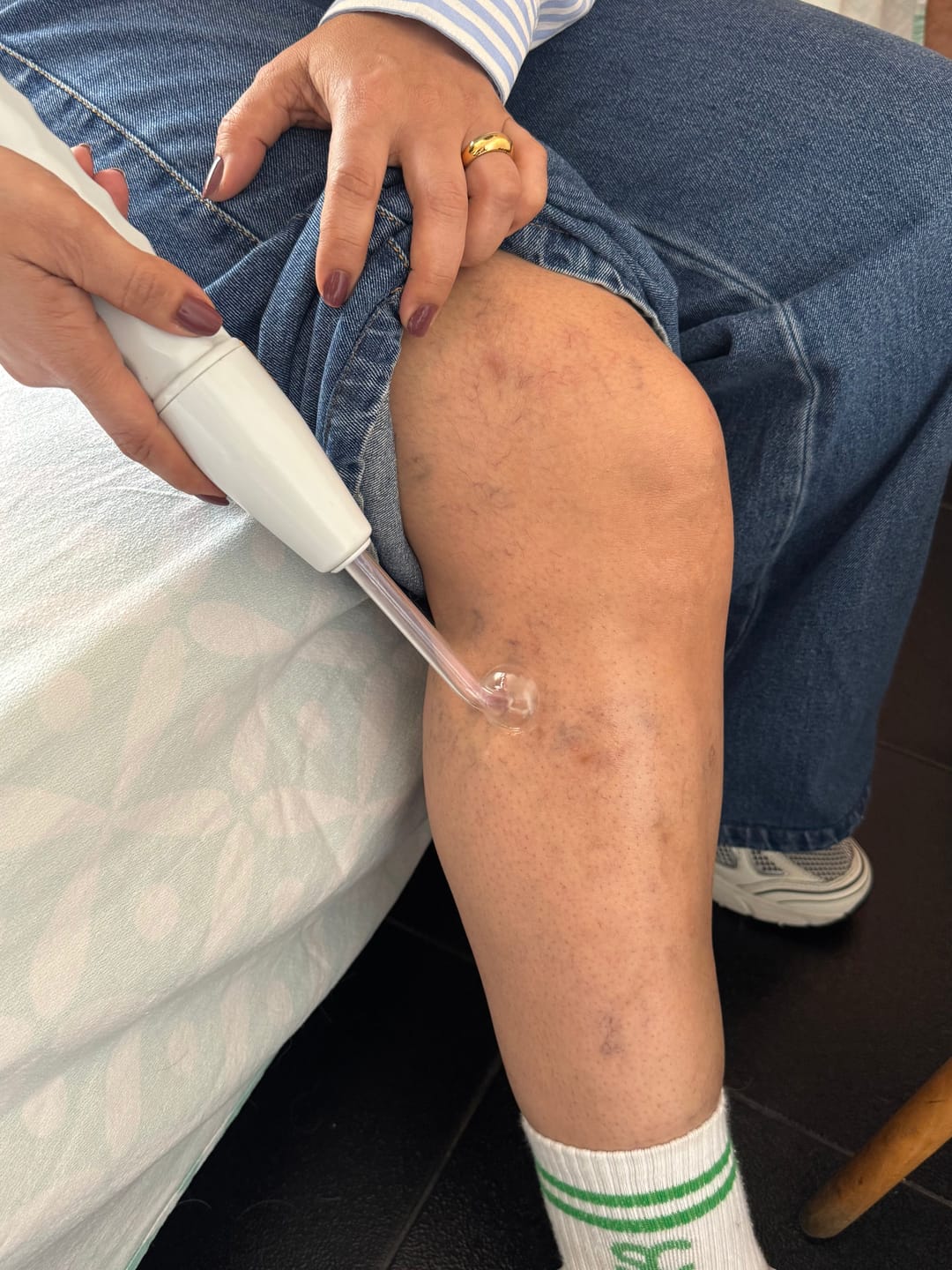 Customer photo review of Thermapulse - VeinErase System