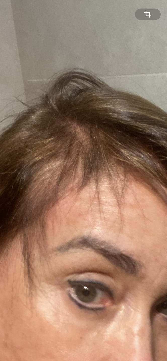Customer photo review of Tónico Anticaída uso diario con resultados visibles desde 2 semanas