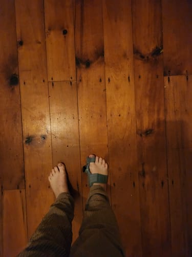 Customer photo review of Treatmedy™ Bunion Fix - Natural At-Home Bunion Relief