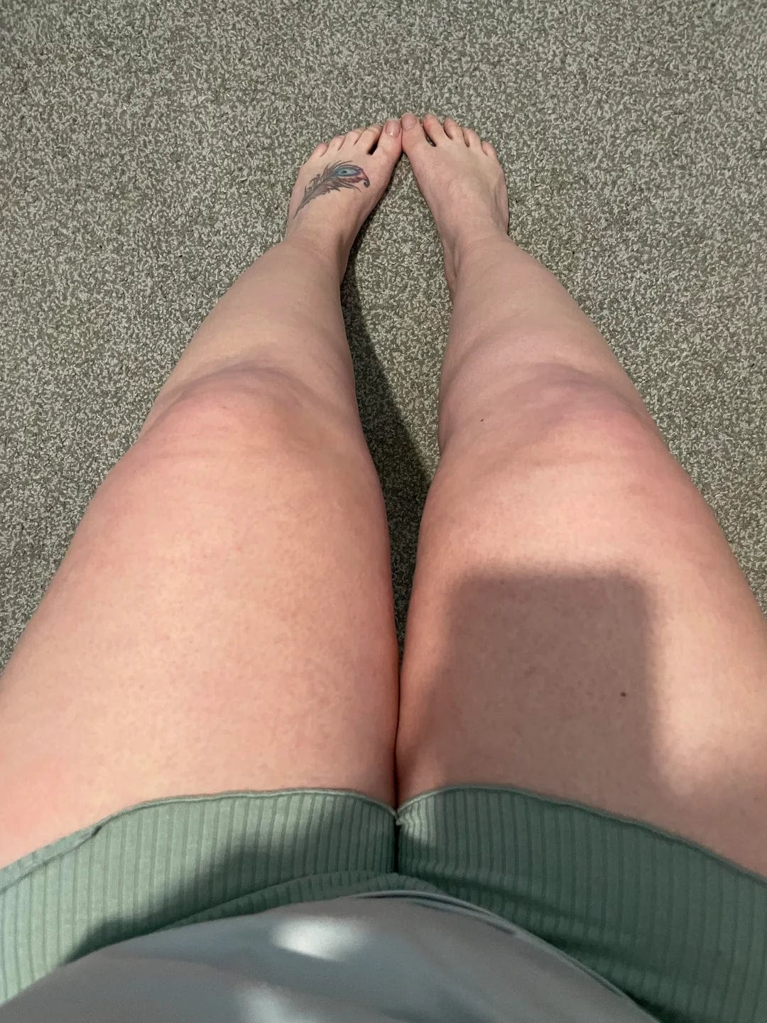 Customer photo review of Thermapulse - VeinErase System