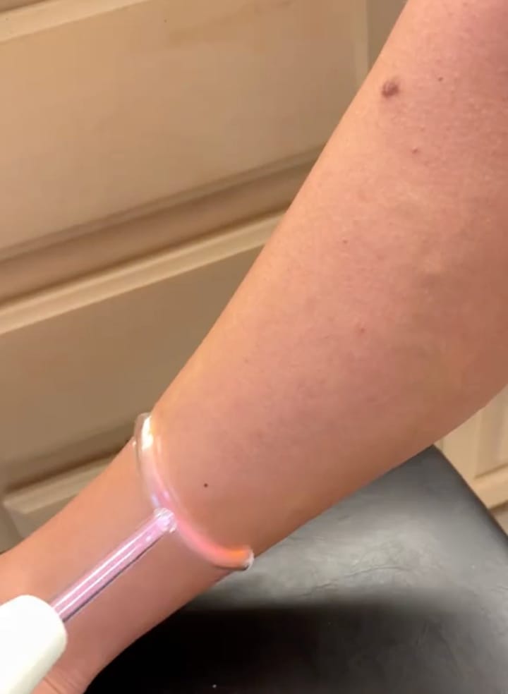 Customer photo review of Thermapulse - VeinErase System