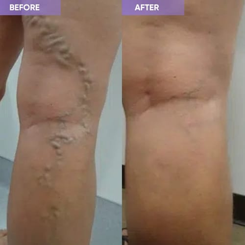 Customer photo review of Thermapulse - VeinErase System