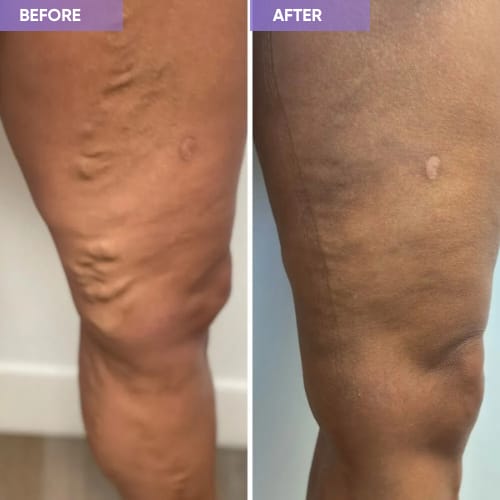 Customer photo review of Thermapulse - VeinErase System