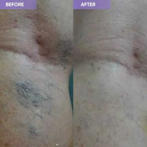 Customer photo review of Thermapulse - VeinErase System