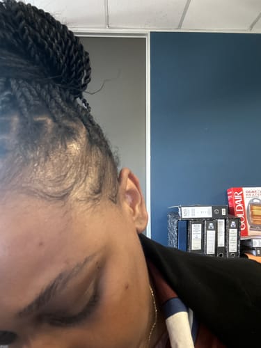 Customer photo review of Hairline Fortifying Serum 30ml - Minoxidil