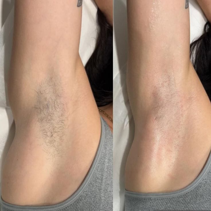 Customer photo review of VelvetaSkin™ - מכשיר להסרת שיער.
