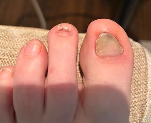 Customer photo review of Onychom - Antifungal Laser Device