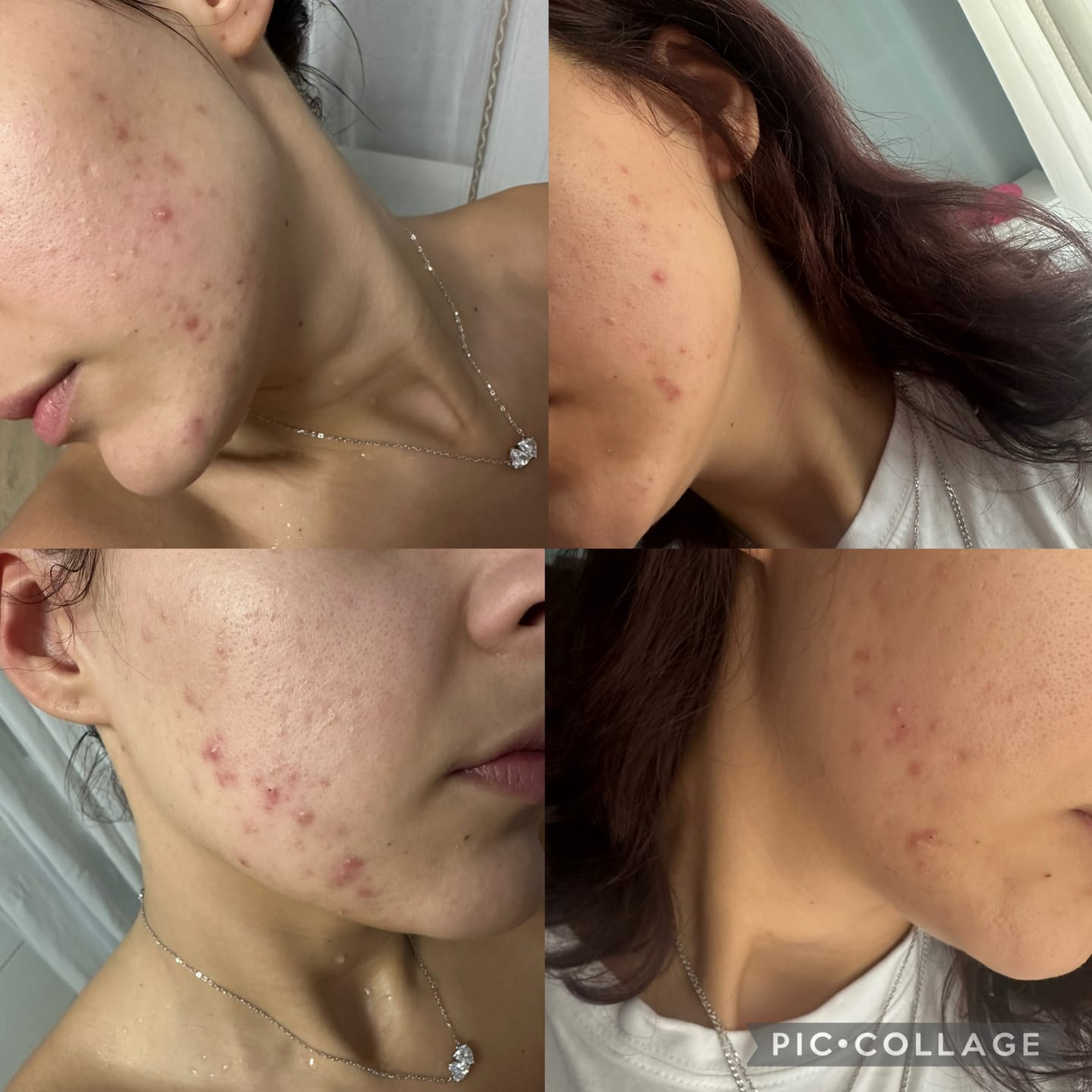 Customer photo review of Dr. Tisha AC7 Анти акне серум с микроигли (спикули)