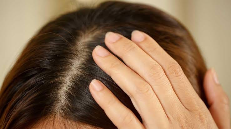Customer photo review of Fulica™ - Anti Dandruff Shampoo