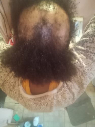 Customer photo review of Rennora EXTRA-Strength Hair Growth Serum